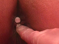 Cutouts: Treatment with laxative suppositories and enemas